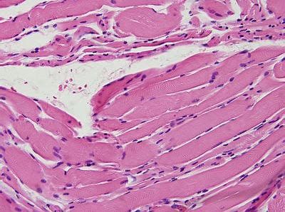 靶向Hippo信号通路或可有用治疗肉瘤